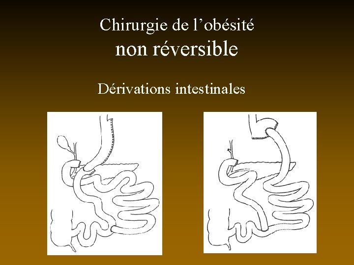 Chirurgie de l’obésité non réversible Dérivations intestinales 