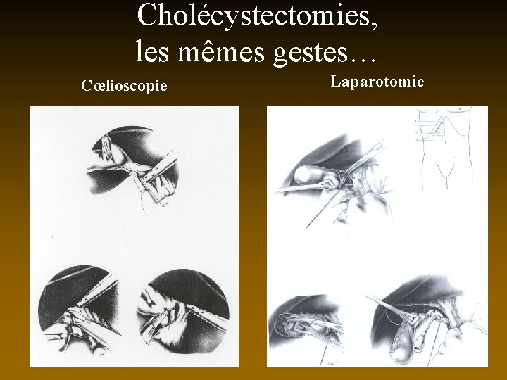 Cholécystectomies, les mêmes gestes… Cœlioscopie Laparotomie 