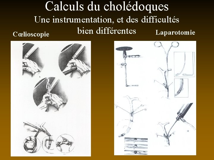 Calculs du cholédoques Une instrumentation, et des difficultés bien différentes Laparotomie Cœlioscopie 