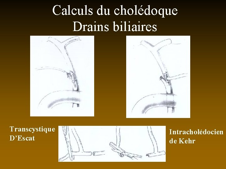 Calculs du cholédoque Drains biliaires Transcystique D’Escat Intracholédocien de Kehr 