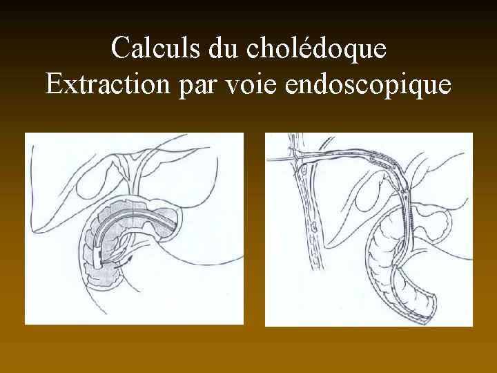 Calculs du cholédoque Extraction par voie endoscopique 
