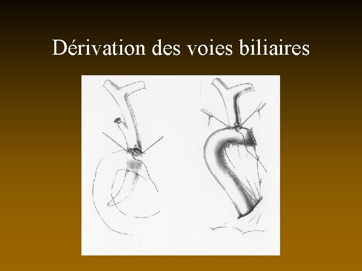 Dérivation des voies biliaires 
