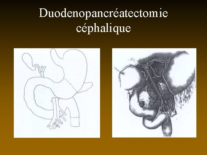 Duodenopancréatectomie céphalique 
