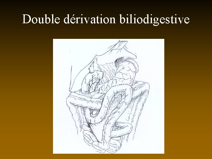 Double dérivation biliodigestive 