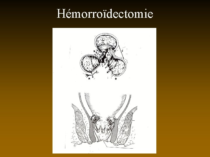 Hémorroïdectomie 