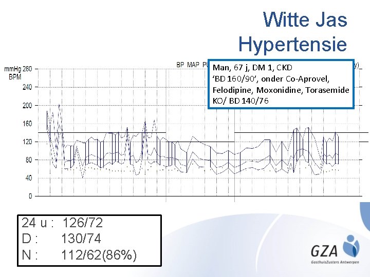 Witte Jas Hypertensie Man, 67 j, DM 1, CKD ‘BD 160/90’, onder Co-Aprovel, Felodipine,