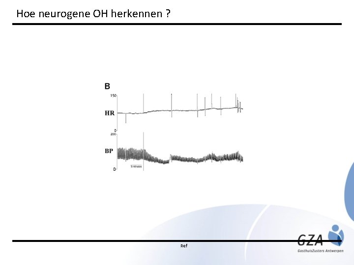 Hoe neurogene OH herkennen ? Ref 