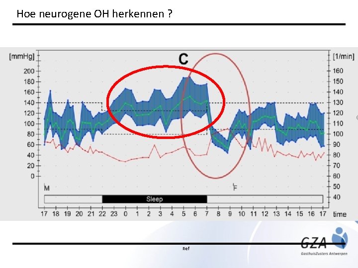 Hoe neurogene OH herkennen ? Ref 