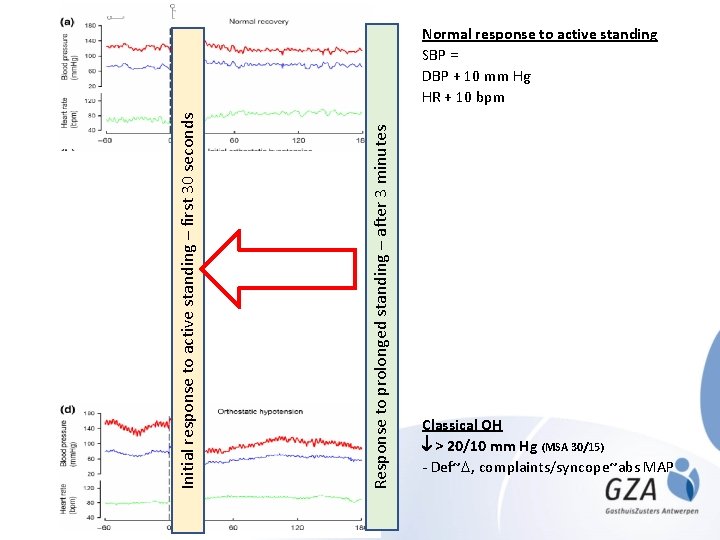 Response to prolonged standing – after 3 minutes Initial response to active standing –