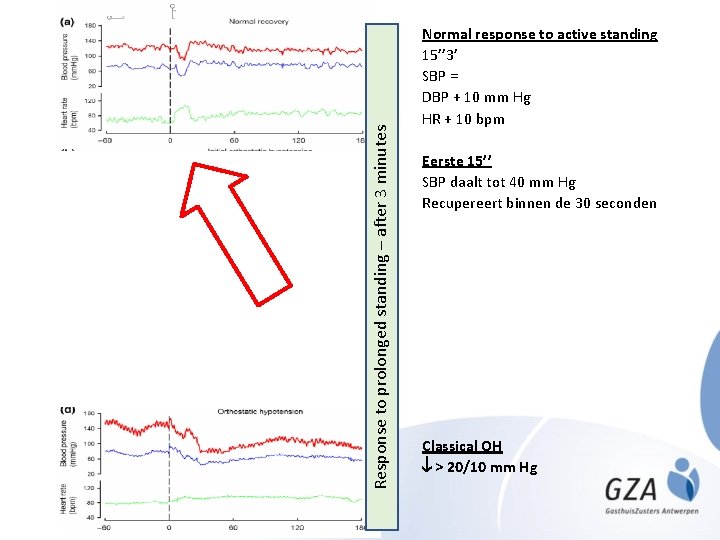 Response to prolonged standing – after 3 minutes Normal response to active standing 15’’