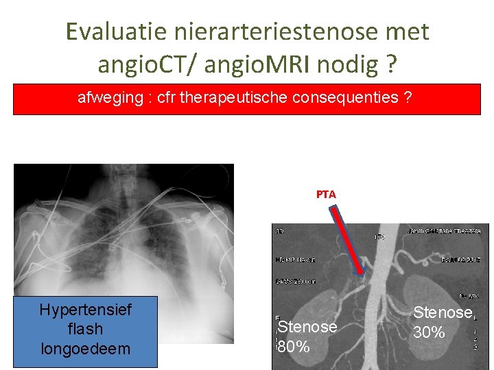 Evaluatie nierarteriestenose met angio. CT/ angio. MRI nodig ? afweging : cfr therapeutische consequenties