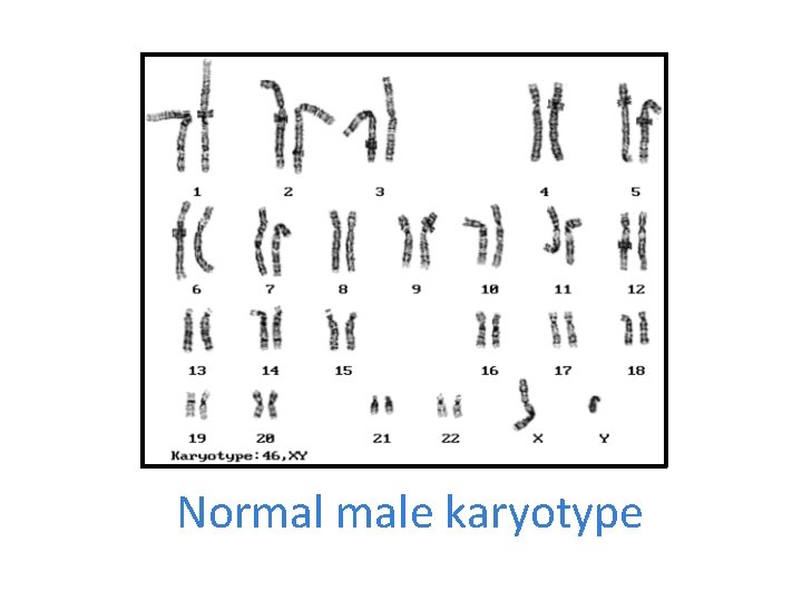 Normal male karyotype 
