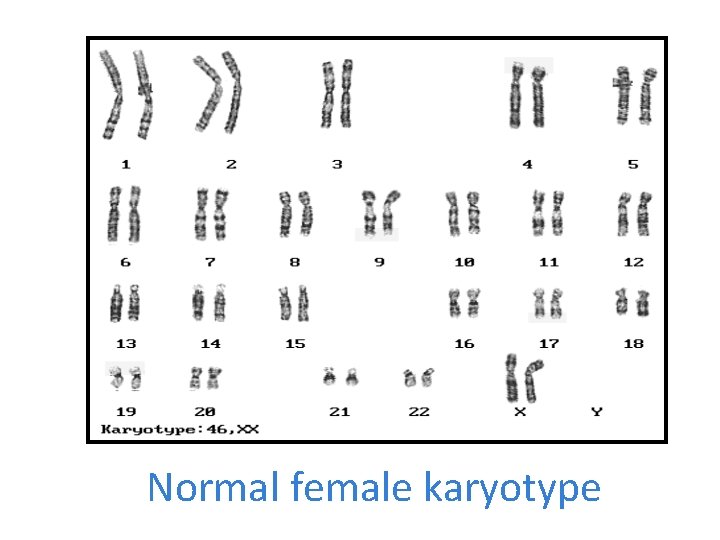 Normal female karyotype 