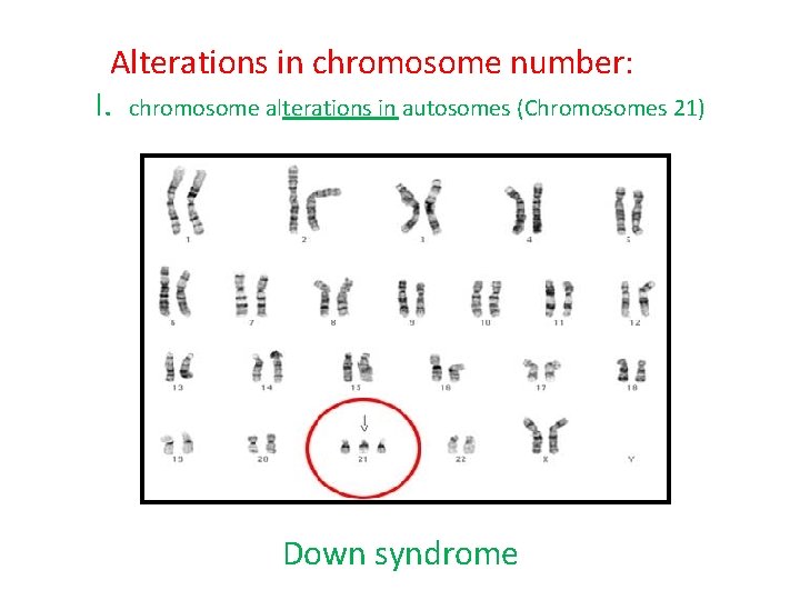 Alterations in chromosome number: I. chromosome alterations in autosomes (Chromosomes 21) Down syndrome 