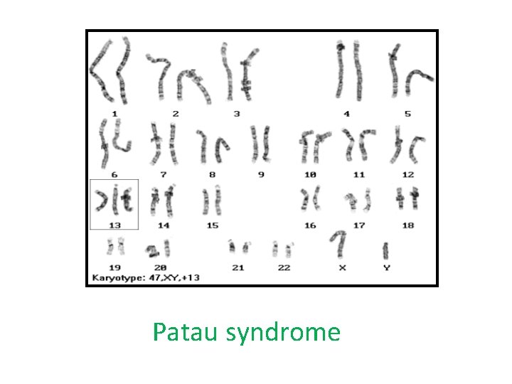 Patau syndrome 