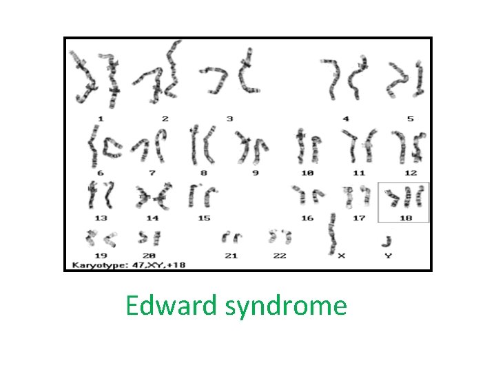 Edward syndrome 