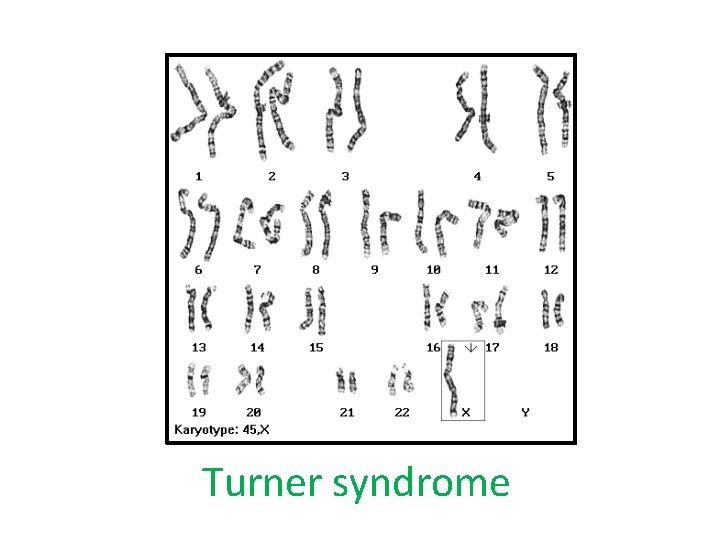 Turner syndrome 