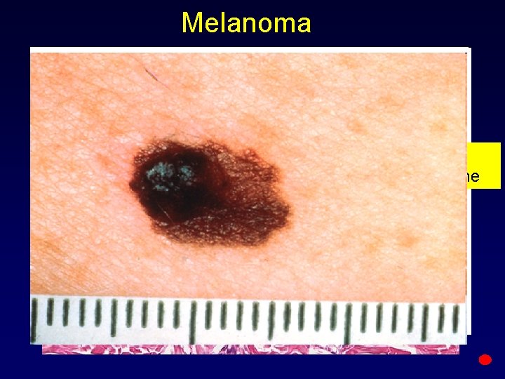 Melanoma epidermis basal membrane invasive derma growth 