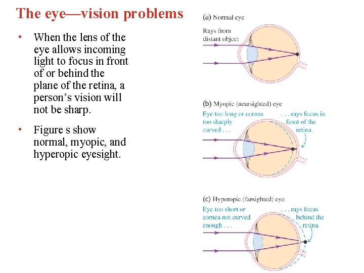 The eye—vision problems • When the lens of the eye allows incoming light to