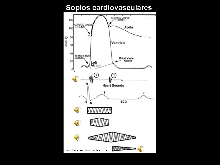 Soplos cardiovasculares www. iun. edu - www. dundee. ac. uk 