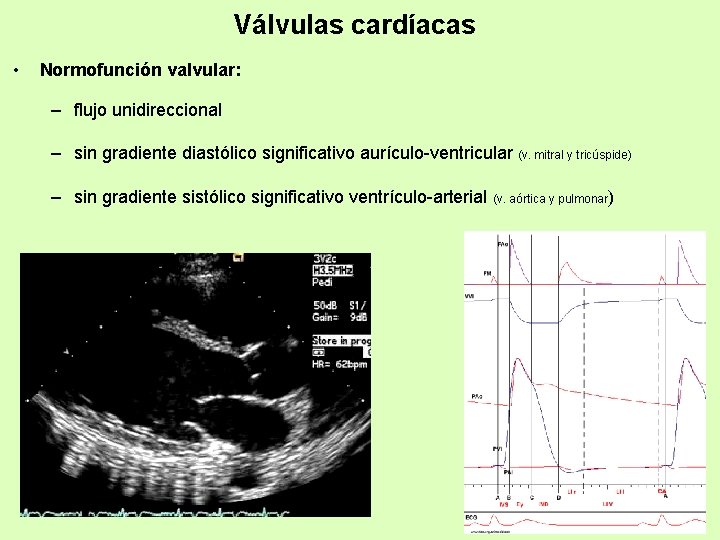 Válvulas cardíacas • Normofunción valvular: – flujo unidireccional – sin gradiente diastólico significativo aurículo-ventricular