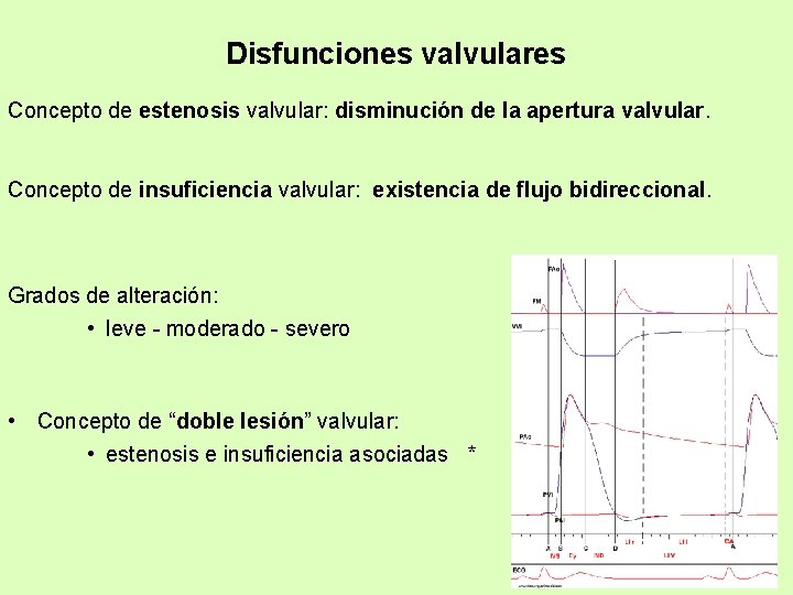 Disfunciones valvulares Concepto de estenosis valvular: disminución de la apertura valvular. Concepto de insuficiencia