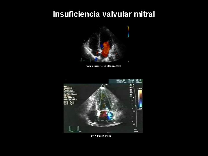 Insuficiencia valvular mitral www. echobasics. de/tte-cas. html Dr. Adrián D´Ovidio 