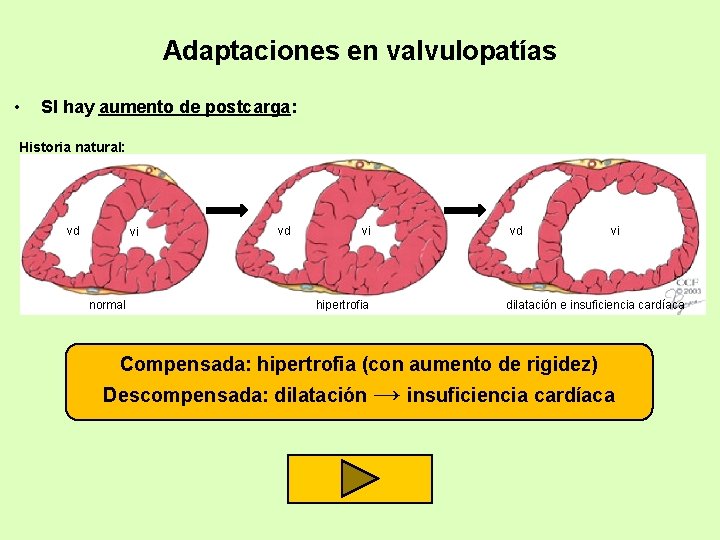 Adaptaciones en valvulopatías • SI hay aumento de postcarga: Historia natural: vd vi normal