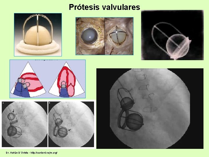 Prótesis valvulares Dr. Adrián D’Ovidio - http: //content. nejm. org/ 