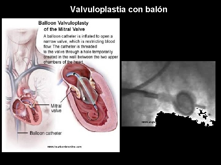 Valvuloplastia con balón www. angiogenesis-center. org www. heartcenteronline. com 