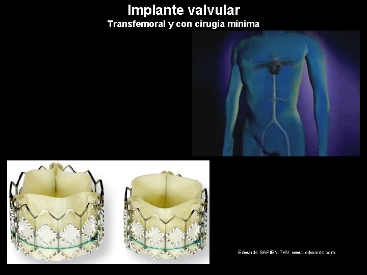 Implante valvular Transfemoral y con cirugía mínima Edwards SAPIEN THV www. edwards. com 