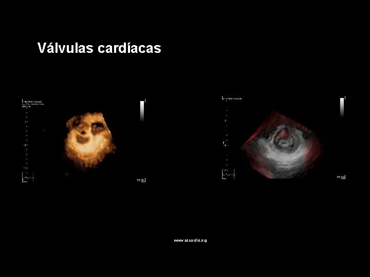 Válvulas cardíacas www. escardio. org 