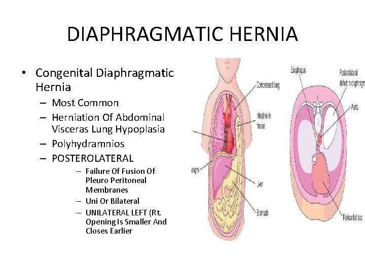 DIAPHRAGMATIC HERNIA • Congenital Diaphragmatic Hernia – Most Common – Herniation Of Abdominal Visceras