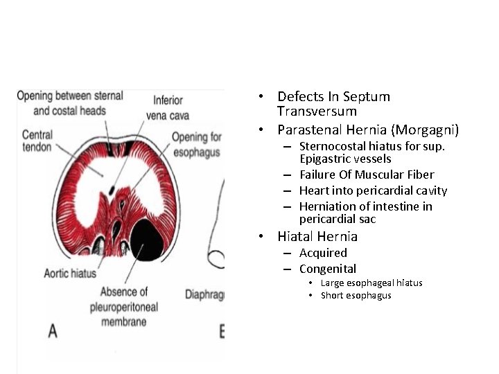  • Defects In Septum Transversum • Parastenal Hernia (Morgagni) – Sternocostal hiatus for