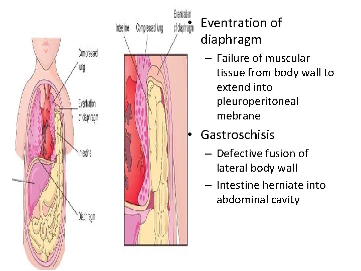  • Eventration of diaphragm – Failure of muscular tissue from body wall to