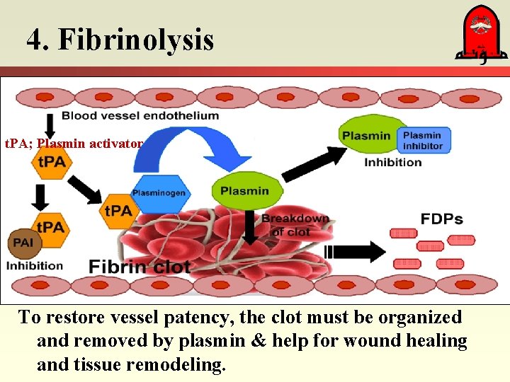4. Fibrinolysis t. PA; Plasmin activator To restore vessel patency, the clot must be