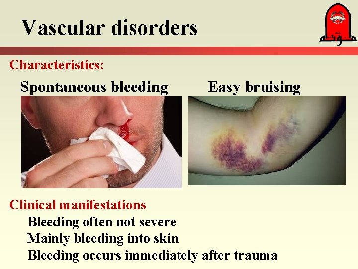 Vascular disorders Characteristics: Spontaneous bleeding Easy bruising Clinical manifestations Bleeding often not severe Mainly