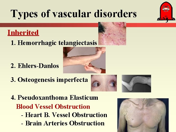 Types of vascular disorders Inherited 1. Hemorrhagic telangiectasis 2. Ehlers-Danlos 3. Osteogenesis imperfecta 4.