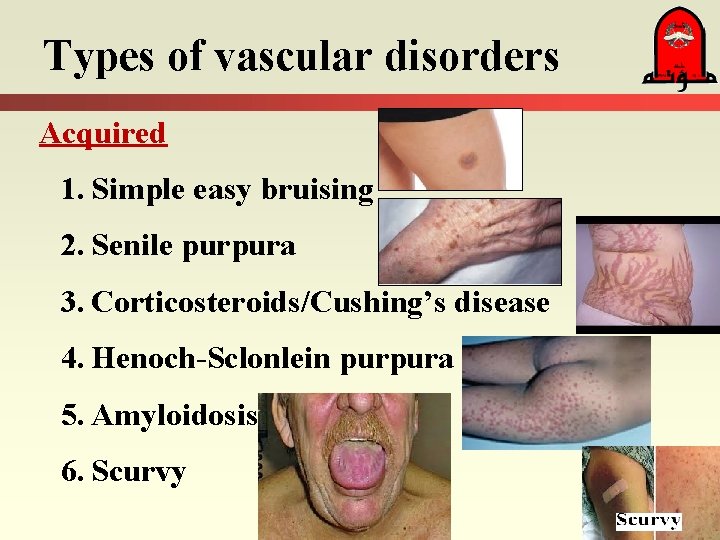 Types of vascular disorders Acquired 1. Simple easy bruising 2. Senile purpura 3. Corticosteroids/Cushing’s