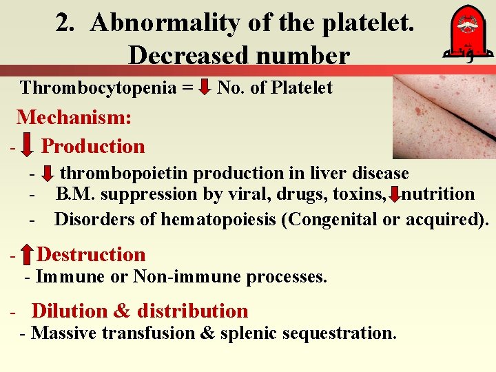 2. Abnormality of the platelet. Decreased number Thrombocytopenia = No. of Platelet Mechanism: -