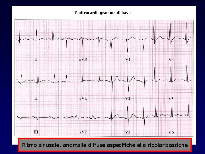 Elettrocardiogramma di base Ritmo sinusale, anomalie diffuse aspecifiche ella ripolarizzazione 