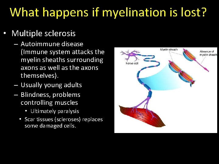 What happens if myelination is lost? • Multiple sclerosis – Autoimmune disease (Immune system