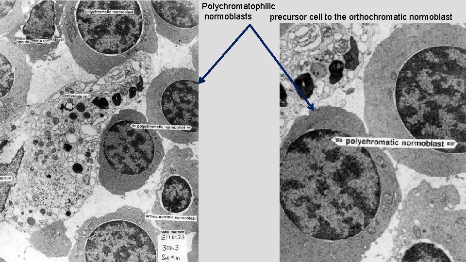 Polychromatophilic normoblasts precursor cell to the orthochromatic normoblast 