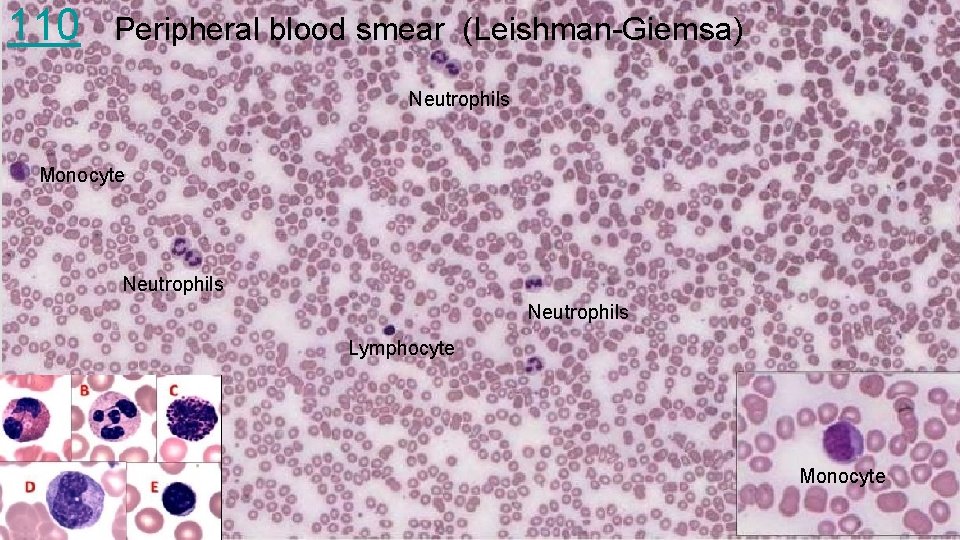 110 Peripheral blood smear (Leishman-Giemsa) Neutrophils Monocyte Neutrophils Lymphocyte Monocyte 