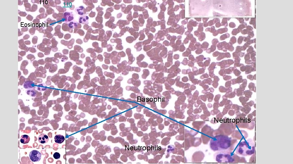 110 Peripheral blood smear (Leishman-Giemsa) Eosinophil basophil, eosinophil, and neutrophils Basophil Neutrophils 