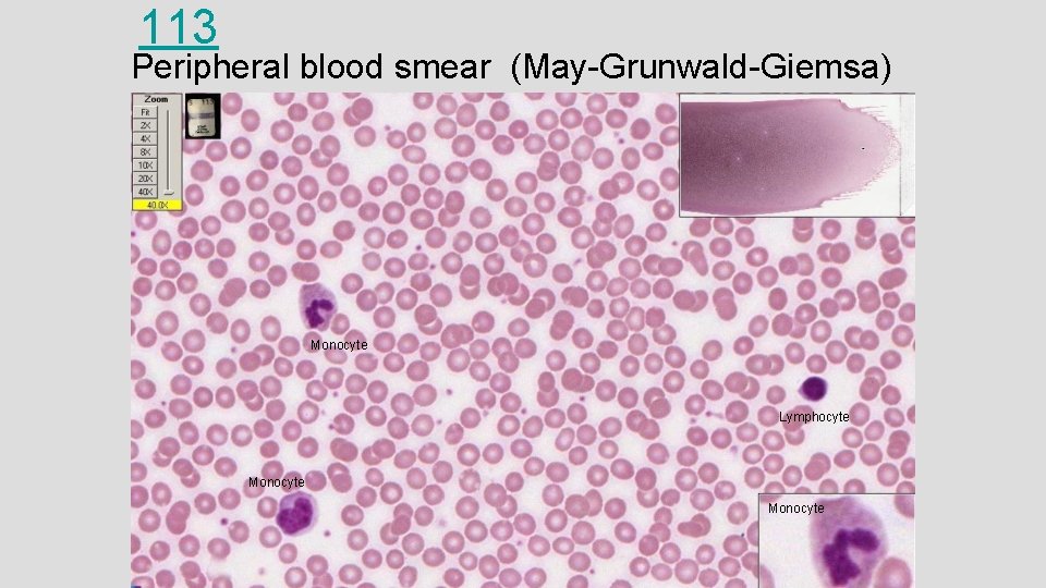 113 Peripheral blood smear (May-Grunwald-Giemsa) Monocyte Lymphocyte Monocyte 