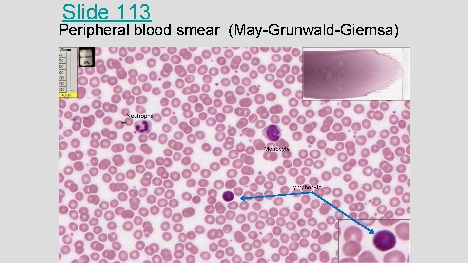 Slide 113 Peripheral blood smear (May-Grunwald-Giemsa) Lymphocyte 