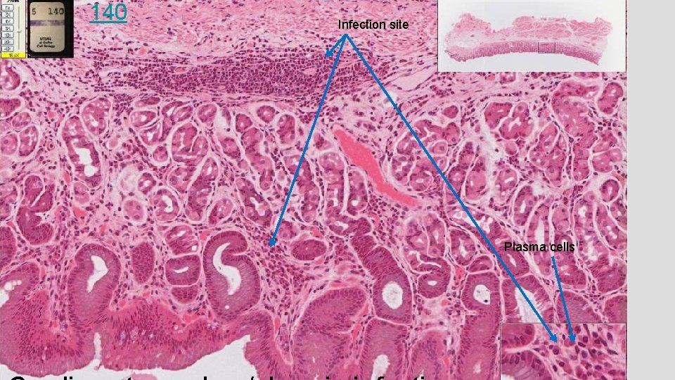 140 Infection site Plasma cells 