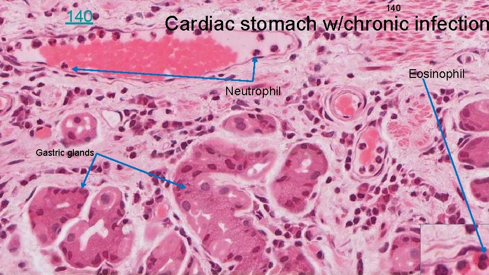 140 Cardiac stomach w/chronic infection Eosinophil Neutrophil Gastric glands 