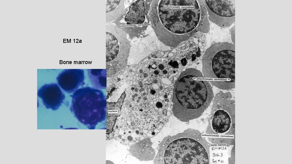 EM 12 a Bone marrow 